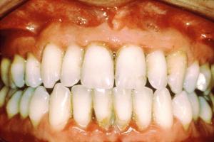 periodontitis